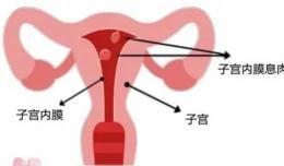 【欽二醫(yī)生說】小小子宮內膜息肉 除了引起出血還可導致“不孕”